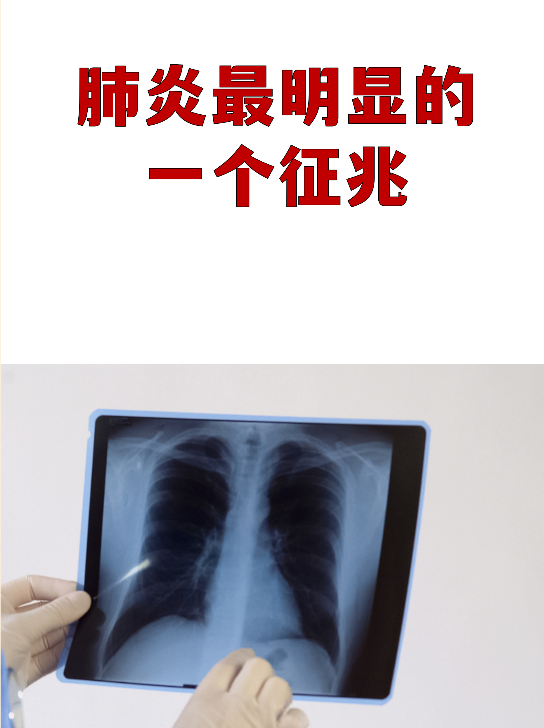 陕西新增24例新型肺炎〃陕西新增24例新型肺炎病例-第2张图片